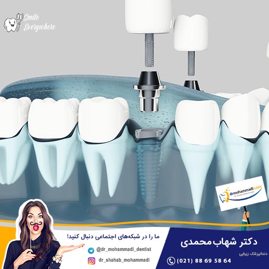 مراحل کاشت ایمپلنت دندان: توضیح گام به گام - کلینیک دندانپزشکی دکتر شهاب محمدی